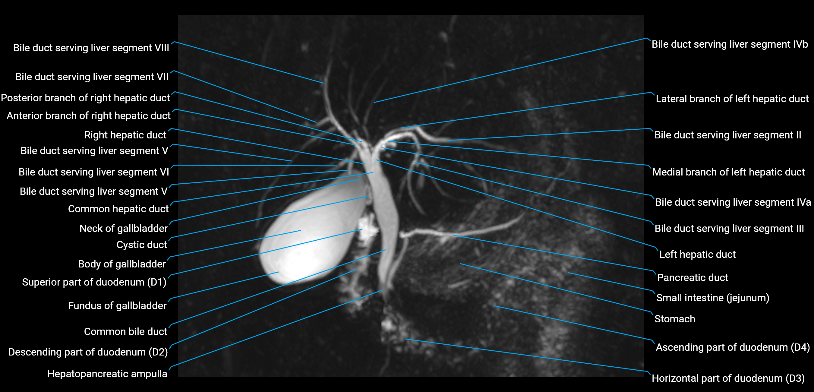 MRCP MIP MRI  anatomy labelled image-img-01003-00012.png